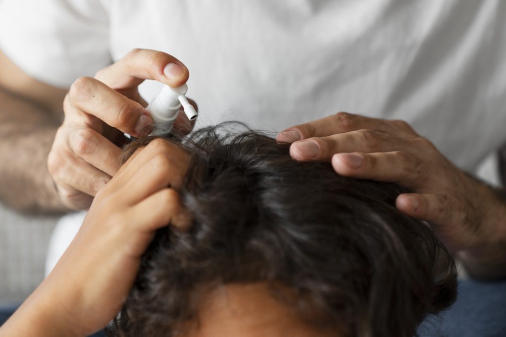 Minoxidil tópico para tratamento capilar