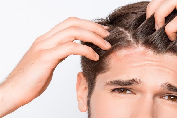 Como saber se tenho dermatite no couro cabeludo?
