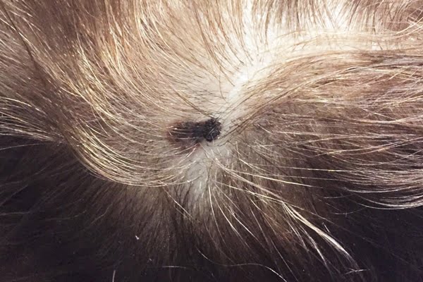 Câncer no couro cabeludo: quando suspeitar?