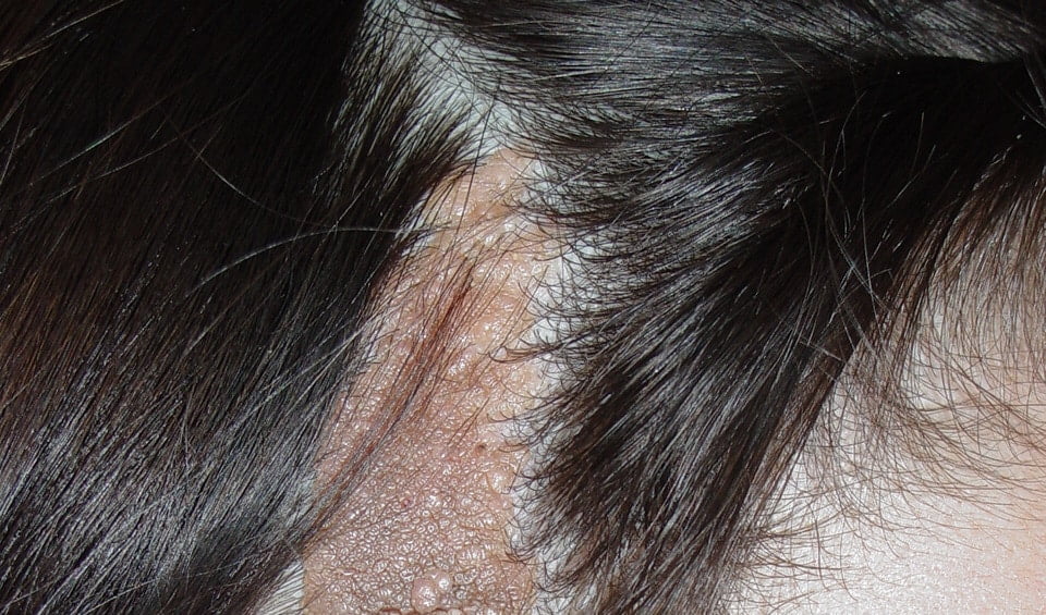 Nevo sebáceo: conheça esse sinal no couro cabeludo