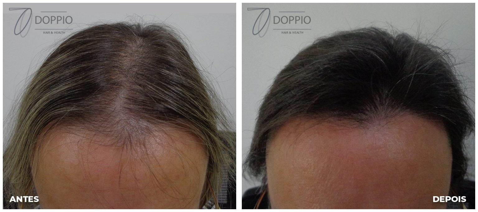 Resultados de tratamento capilar | Antes e depois, homem, mulher